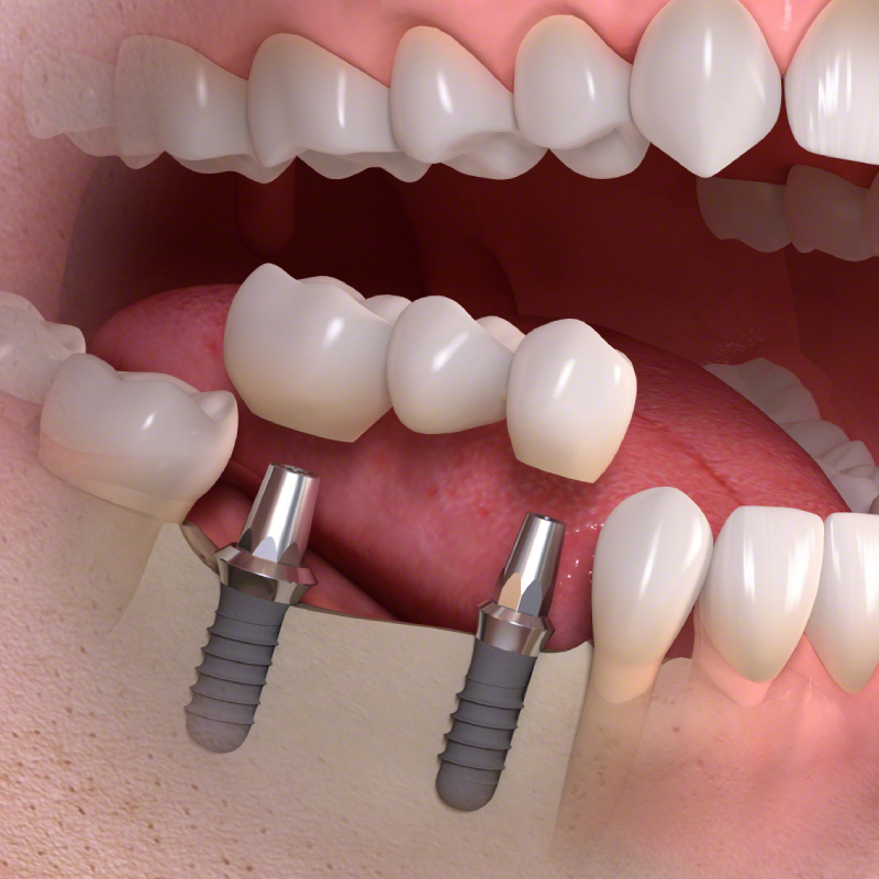Peak Periodontal and Dental Implant Specialists Implants