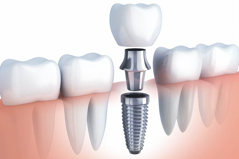 Implants Dentist in Carmel
